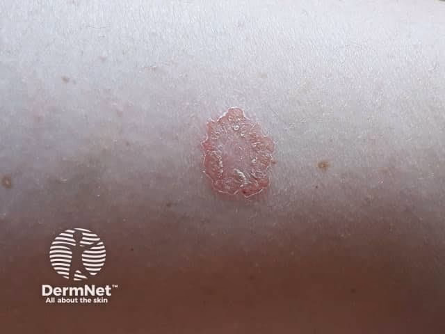 How do you treat coin dermatitis?