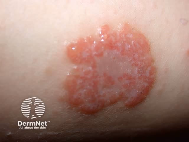 What causes coin shaped eczema?