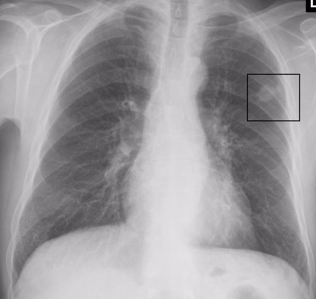 What is a lesion in lung cancer?