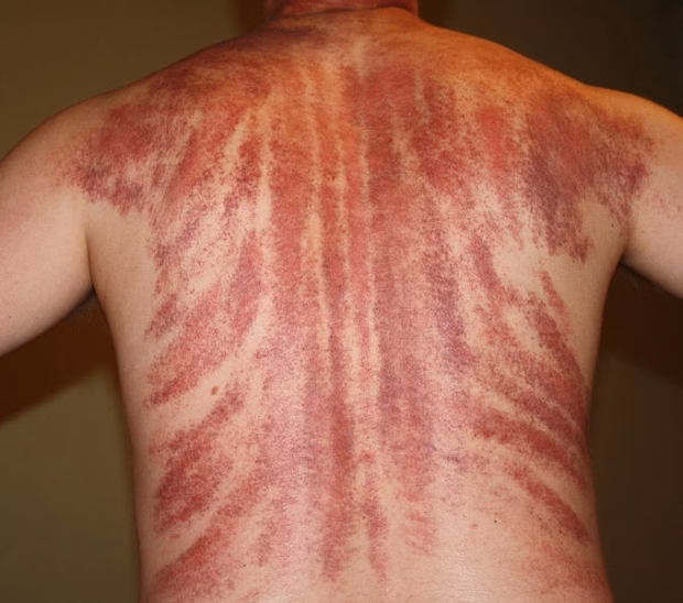 What is coin scratching?