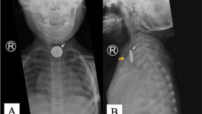 What is the coin sign on xray?