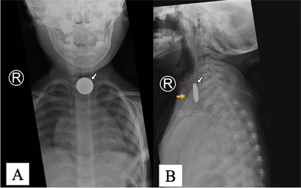 What is the coin sign on xray?