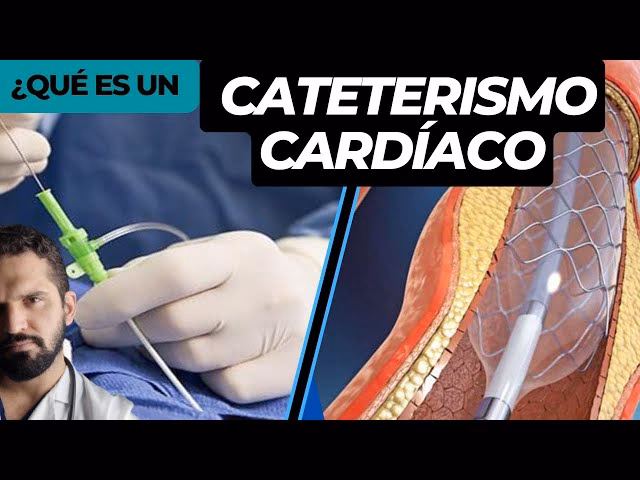 ¿Qué es una malla stent?
